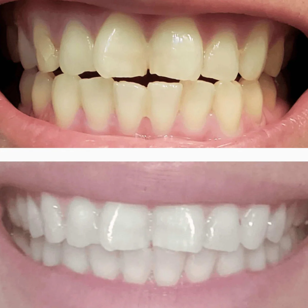SNOW® Diamond Series Teeth Whitening Kit | Professional Whitening at Home (1 Serum) - Image 8