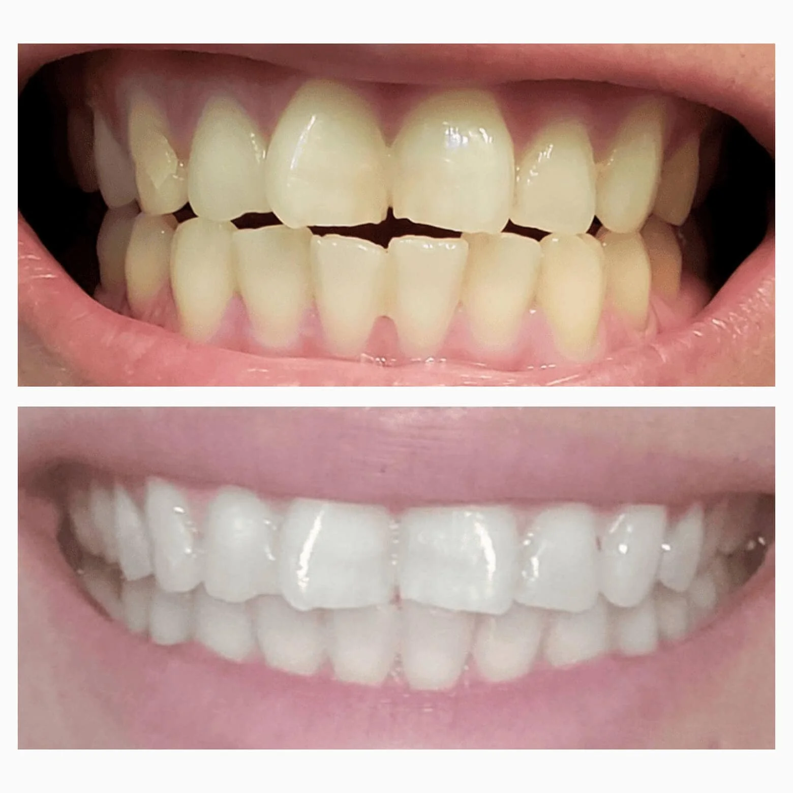 SNOW® LED Teeth Whitening Mouthpiece - Image 3