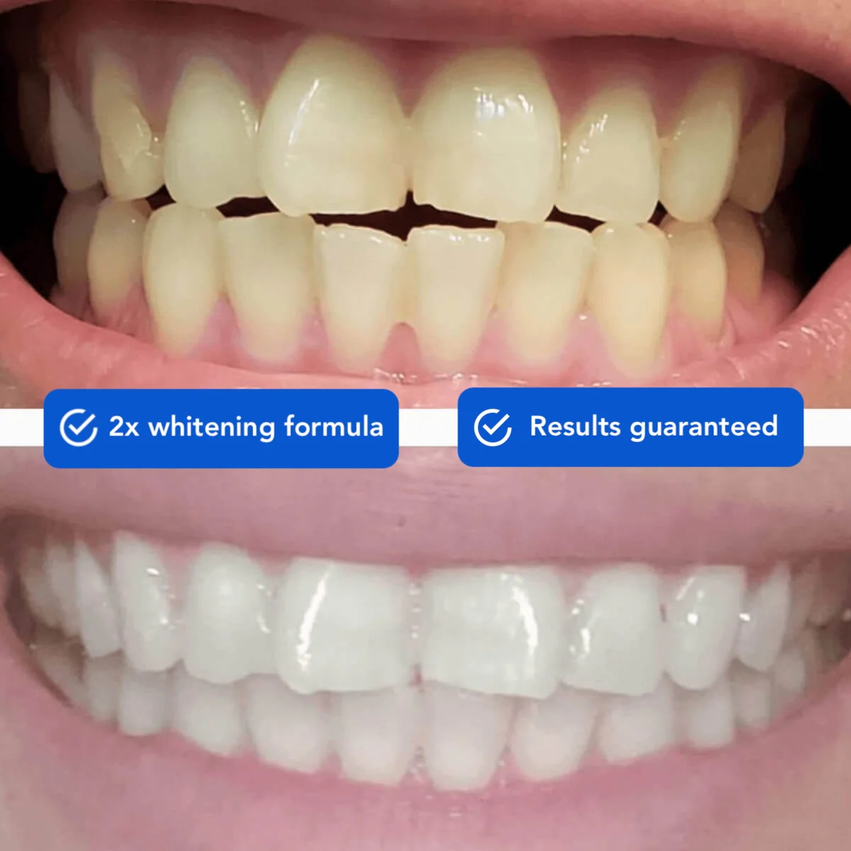 SNOW® DiamondSeries® Wireless | Professional Teeth Whitening Kit - Image 5